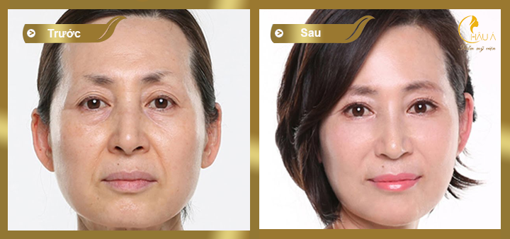 hình ảnh khách hàng trước và sau khi nâng cơ xóa nhăn không phẫu thuật 2