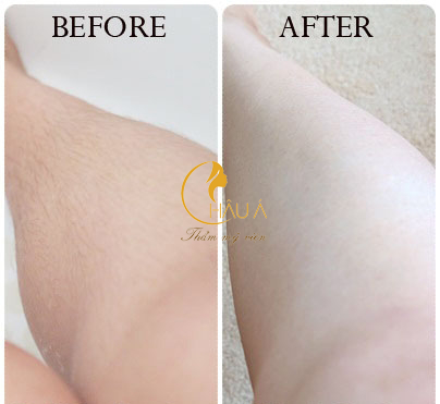 hình ảnh trước sau của dịch vụ triệt lông bằng laze 2