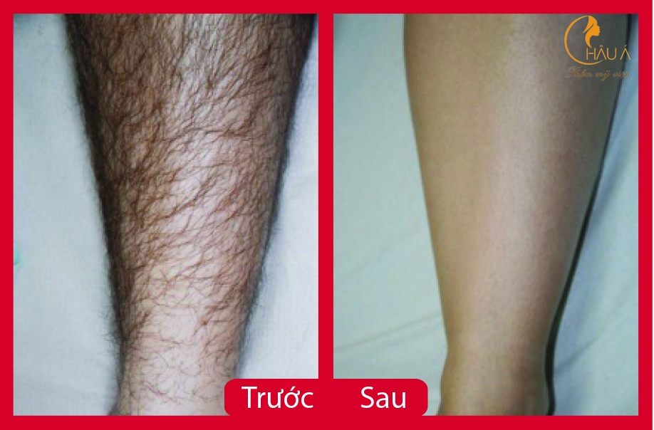 hình ảnh trước sau của dịch vụ triệt lông bằng laze 3