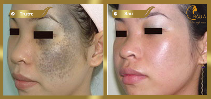 hình ảnh trước và sau khi điều trị xóa vết chàm tại châu á 2