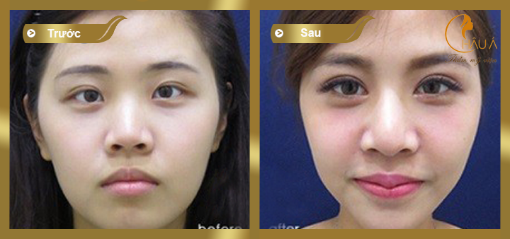 hình ảnh trước và sau khi mở rộng hóc mắt 3