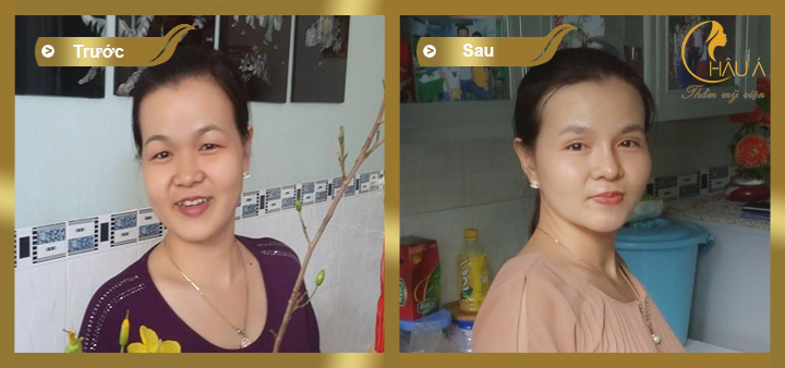 hình ảnh trước và sau khi nâng mũi bọc sụn tại thẩm mỹ viên Châu Á 2