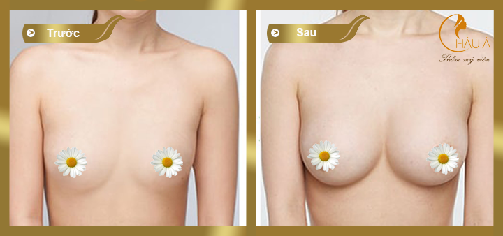 hình ảnh trước và sau khi nâng ngực bằng túi gel natrelle 1
