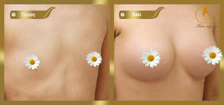 hình ảnh trước và sau khi nâng ngực bằng túi gel natrelle 2