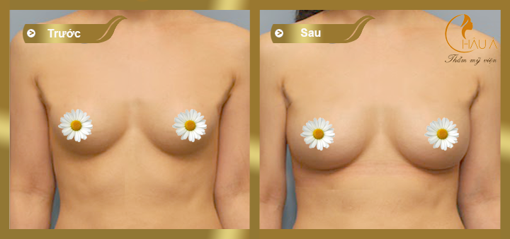 hình ảnh trước và sau khi nâng ngực bằng túi gel natrelle 3