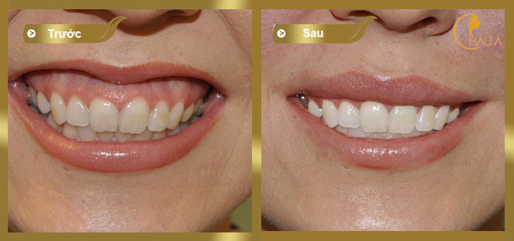 hình ảnh trước và sau khi phẫu thuật chữa cười hở lợi tại châu á 3