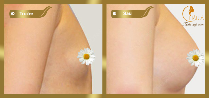 hình ảnh trước và sau khi phẫu thuật nâng ngực bằng túi mentor 1