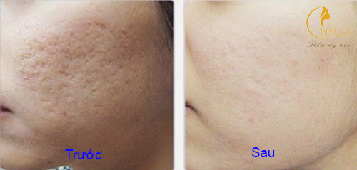 hình ảnh trước và sau khi sử dụng công nghệ trẻ háo da tại châu á 2
