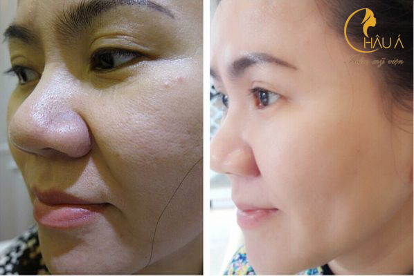 hình ảnh trước và sau khi sử dụng công nghệ trẻ háo da tại châu á 2