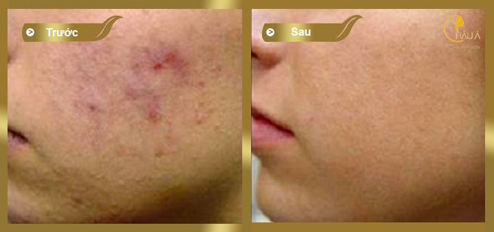 hình ảnh trước và sau khi thực hiện điều trị sẹo bằng cách lăn kim 3