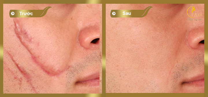 hình ảnh trước và sau khi thực hiện điều trị sẹo lòi bằng co2 practional  tại châu á 3