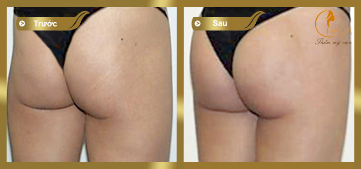 hình ảnh trước và sau khi thực hiện nâng mông nội soi 2