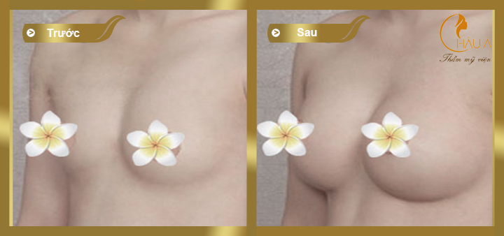 hình ảnh trước và sau khi thực hiện nâng ngực nano tại châu á 2