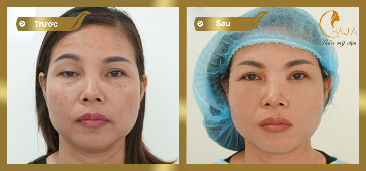 hình ảnh trước và sau khi thực hiện phẫu thuật chữa sụp mí mắt 3