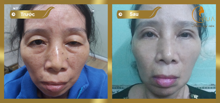 hình ảnh trước và sau khi thực hiện phẫu thuật chữa sụp mí mắt