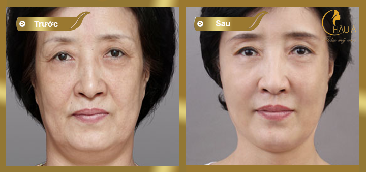 hình ảnh trước và sau khi thực hiện quá trình nâng mũi không phẫu thuật 1