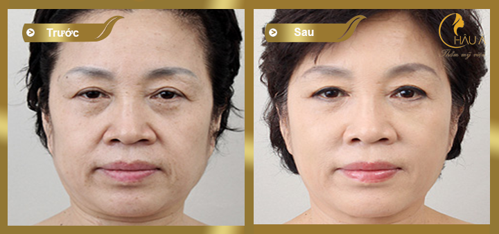 hình ảnh trước và sau khi thực hiện quá trình nâng mũi không phẫu thuật 3