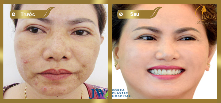 hình ảnh trước và sau khi thực hiện trẻ hóa da bằng laze 2