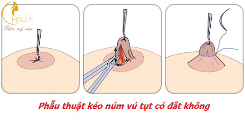 phẫu thuật đầu ngực bị tuột vào trong được thực hiện như thế nào