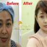 Hình ảnh trước và sau khi phẫu thuật thẩm mỹ 