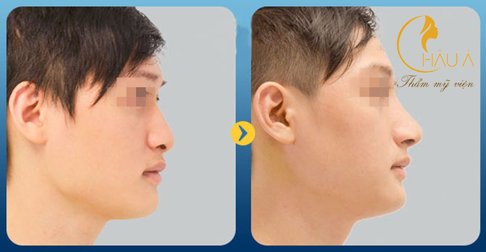 Hình ảnh trước và khi khi nâng mũi cho nam tại thẩm mỹ viện châu á 2