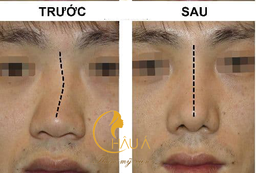 Hình ảnh trước và khi khi nâng mũi cho nam tại thẩm mỹ viện châu á 3