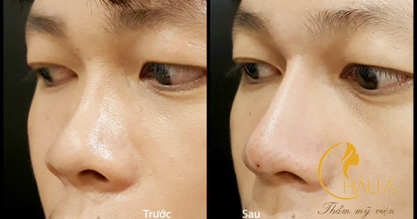 Hình ảnh trước và khi khi nâng mũi cho nam tại thẩm mỹ viện châu á