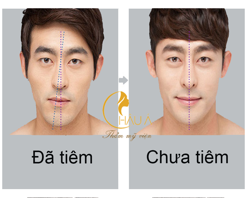 Hình ảnh trước và sau khi tiêm cằm góc cạnh cho nam tại TMV Châu Á