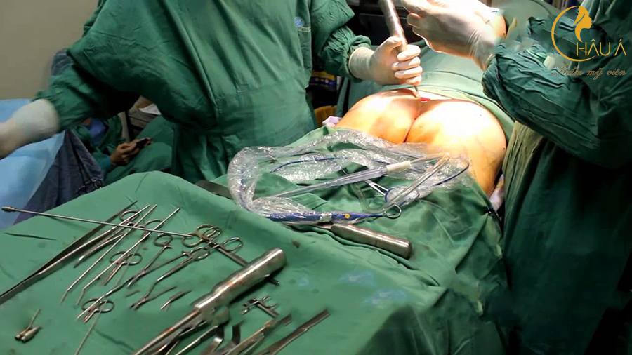 dịch vụ nâng mông nội soi được thực hiện bởi bác sĩ bảo trọng