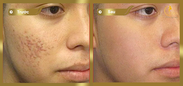 hình ảnh khách hàng trước và sau khi điều trị thâm bằng công nghệ Elight và Peeling 1