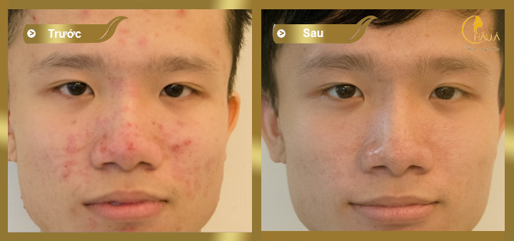 hình ảnh khách hàng trước và sau khi điều trị thâm bằng công nghệ Elight và Peeling 2