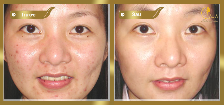 hình ảnh khách hàng trước và sau khi điều trị thâm bằng công nghệ Elight và Peeling 3
