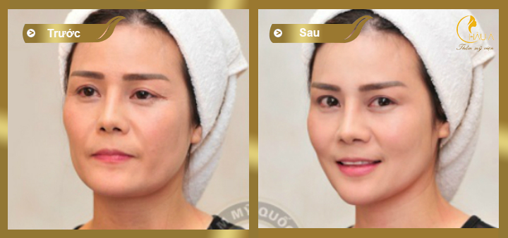 hình ảnh khách hàng trước và sau khi nâng cơ xóa nhăn không phẫu thuật 3