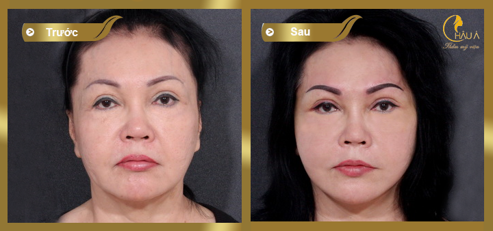 hình ảnh khách hàng trước và sau khi thực hiện căng da mặt toàn phần 1