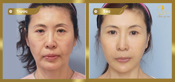 hình ảnh khách hàng trước và sau khi thực hiện căng da mặt toàn phần 2