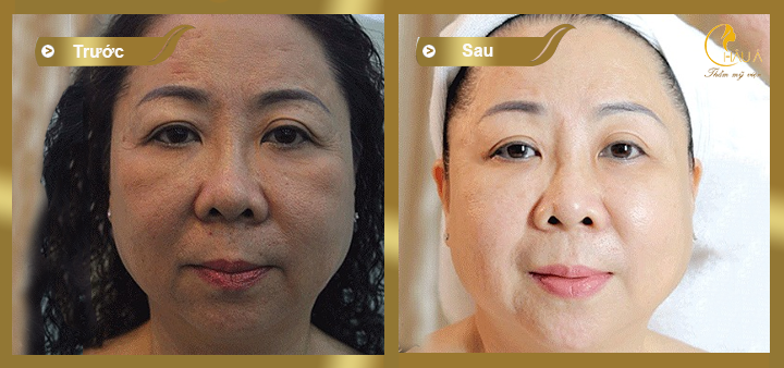 hình ảnh khách hàng trước và sau khi thực hiện căng da mặt toàn phần 3