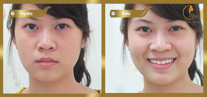 hình ảnh khách hàng trước và sau khi thực hiện tạo má lúm đồng tiền xinh đẹp tại châu á 1