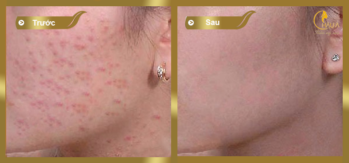 hình ảnh trước và sau khi điều trị mụn bằng công nghệ acne control 1