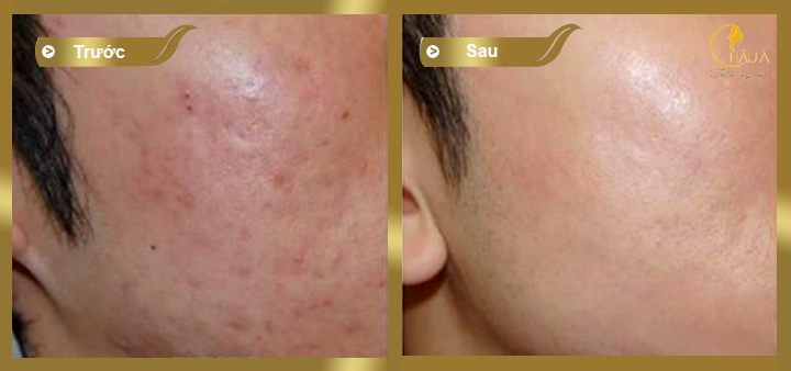 hình ảnh trước và sau khi điều trị mụn bằng công nghệ acne control 2