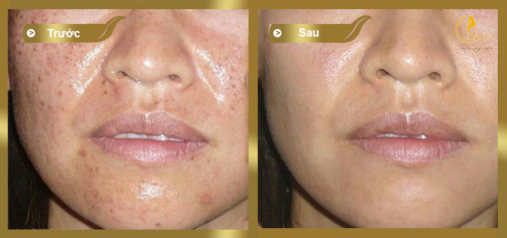 hình ảnh trước và sau khi điều trị mụn bằng công nghệ acne control 3