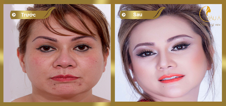 hình ảnh trước và sau khi căng da mặt bằng chỉ 1
