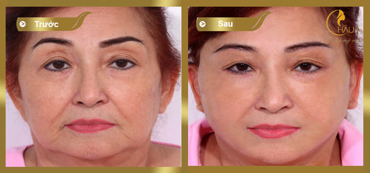 hình ảnh trước và sau khi căng da mặt bằng chỉ 2