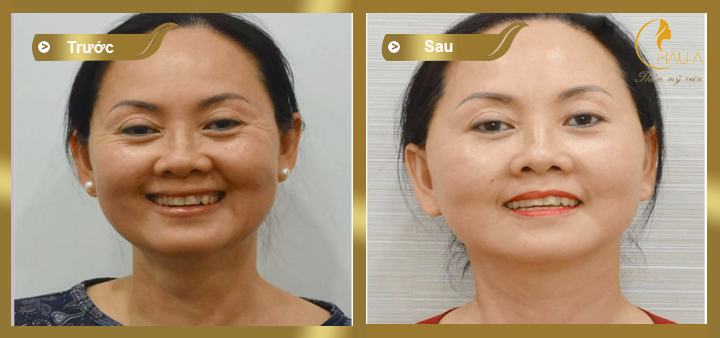hình ảnh trước và sau khi căng da mặt bằng chỉ 3