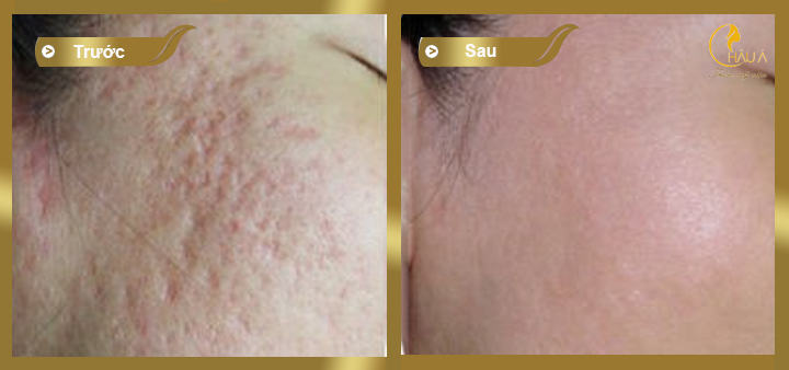 hình ảnh trước và sau khi khách hàng thực hiện điều trị sẹo bằng công nghệ prp 1