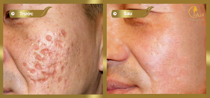 hình ảnh trước và sau khi khách hàng thực hiện điều trị sẹo bằng công nghệ prp 2