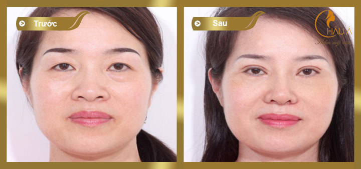 hình ảnh trước và sau khi lấy bọng mỡ mắt 3