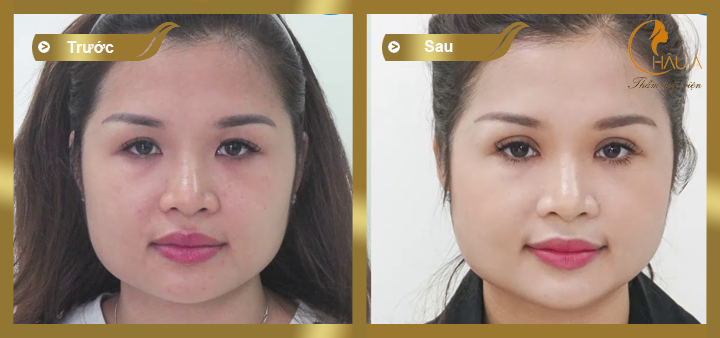 hình ảnh trước và sau khi mở rộng hóc mắt 2
