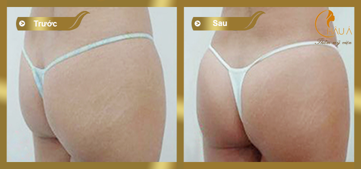hình ảnh trước và sau khi nâng mông bằng túi gel 1