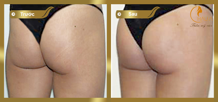 hình ảnh trước và sau khi nâng mông bằng túi gel 2