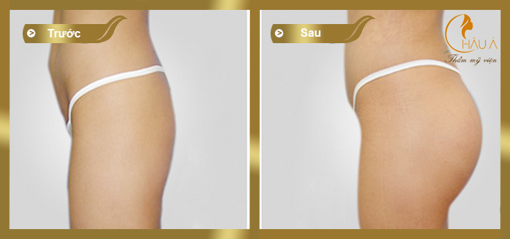hình ảnh trước và sau khi nâng mông bằng túi gel 3